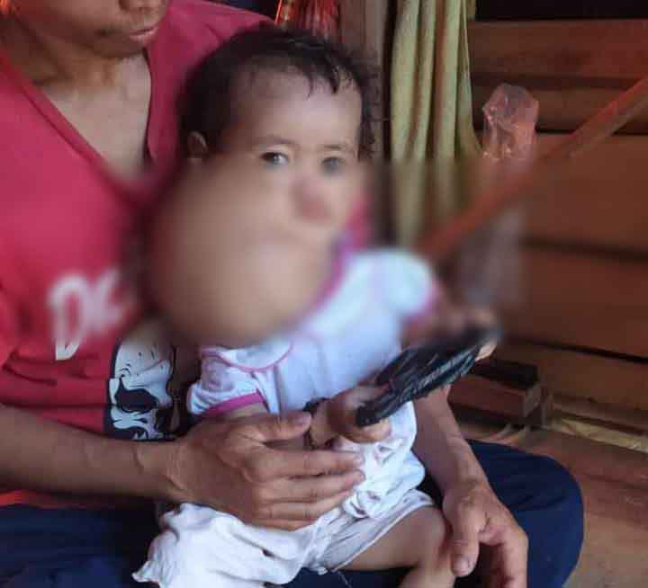 Penyakit Tumor Jinak