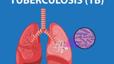 Kasus TBC Meningkat, Kemenkes Kuatkan Sistem Deteksi dan Pelaporan